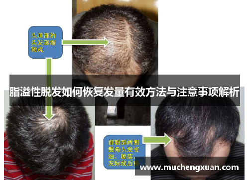 脂溢性脱发如何恢复发量有效方法与注意事项解析 脂溢性脱发如何恢复发量有效方法与注意事项解析